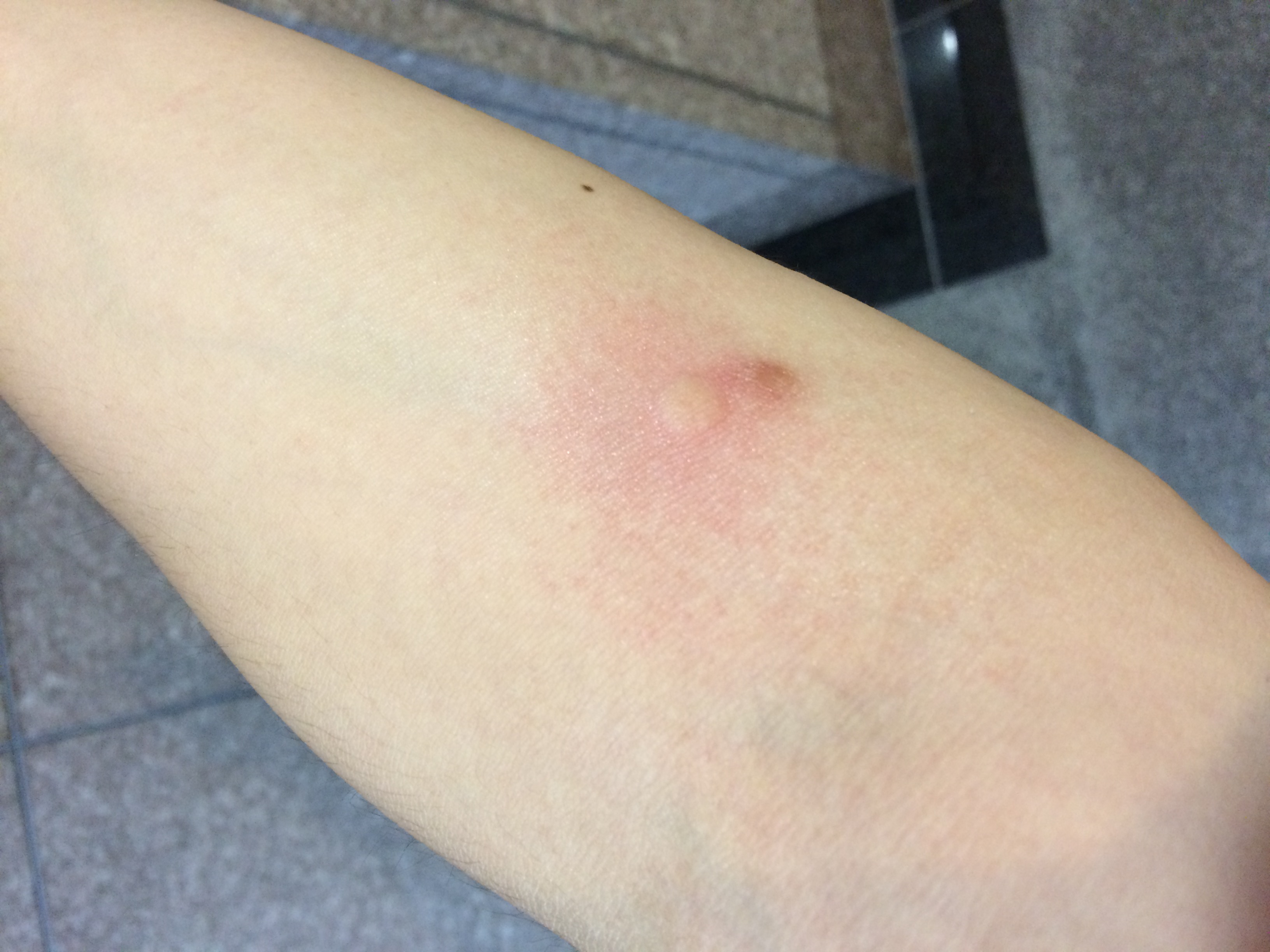 ブヨとは何ですか?